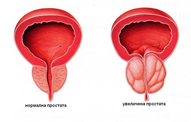 namol sakskaya pentru prostatita)