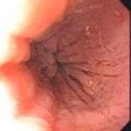 Fluticasone   ,        .