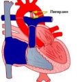  ductus arteriosus       