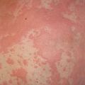  cyclosporine    