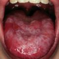 Pioglitazone       