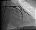 :    IIb/IIIa   STEMI