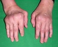 Everolimus       