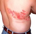 Valacyclovir -      