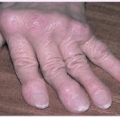         Infliximab