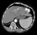   HBV    -         