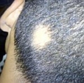         alopecia areata