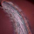   -     ,  paclitaxel