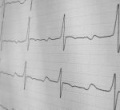 Domperidone  QT   