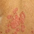Ustekinumab -        