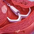 Levonorgestrel-       