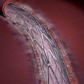 Не бавете PCI след проведена тромболиза по повод STEMI