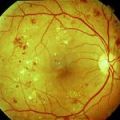 Над 90 милиона страдат от диабетна ретинопатия